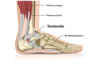How Is an Achilles Tendon Injury Diagnosed?
