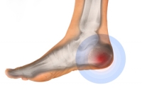 The Many Types of Heel Pain
