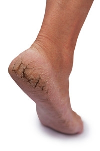 Maintaining Moisture for Cracked Heels
