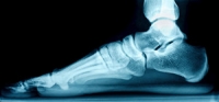 How Flat Feet May Lead to Foot Injuries