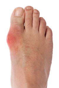 Diets Healthy for Gout