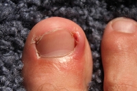 Treatment and Prevention of Ingrown Toenails