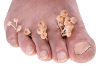 Recipes for Treating Athlete's Foot
