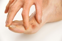 Bunions Can Cause Cosmetic and Physical Concerns
